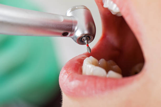 Best Emergency Tooth Extraction in Harper, TX